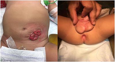 Case Report: A Case Series of Rare High-Type Anorectal Malformations With Perineal Fistula: Beware of Urethral Involvement